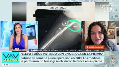 Denuncia que lleva seis años con una broca en su cuerpo tras una negligencia médica: "Es un dolor inexplicable"