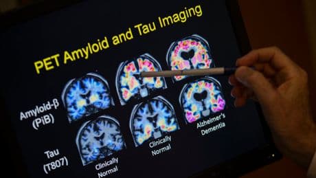 FDA OKs first blood test that can help diagnose Alzheimer's disease