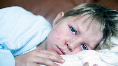 Parents issued urgent measles warning after child dies from 'eliminated' disease