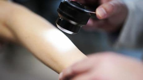UV-Strahlung: Hoher Anstieg von Hautkrebsfällen