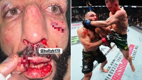 Former UFC champion’s lip RIPPED apart as Dana White shares gruesome picture of star’s injuries after bloody defeat