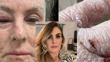 Scots mum with eczema says using steroid creams for 40 years 'has ruined life'