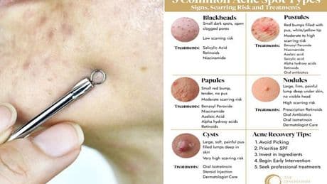 I ended up in A&E after popping a pimple in a specific 'danger' area on my face - I won't make the same mistake again