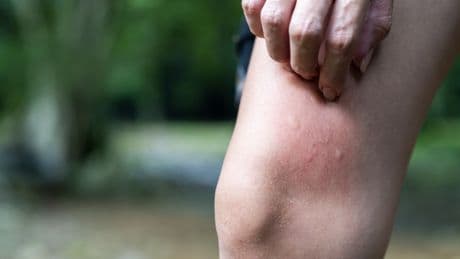 Mehrfach-Angriff: Stechen Mücken wirklich mehrmals zu?