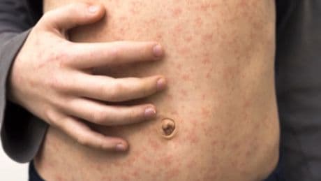 Measles cases in Alberta 6 times higher than other western provinces combined