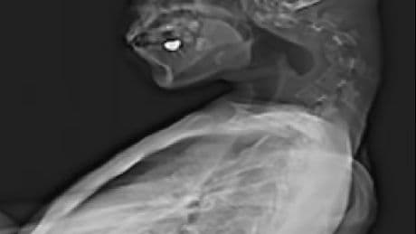 25enne passa ore e ore a giocare sul cellulare e sviluppa la ‘sindrome della testa bassa’. L’allarme dei medici: “Fenomeno in aumento, attenzione”