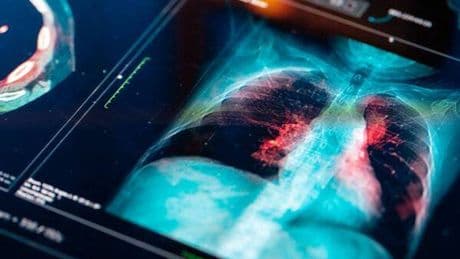 El sorprendente vínculo entre lo que comes y el cáncer de pulmón: las revelaciones de un nuevo estudio científico
