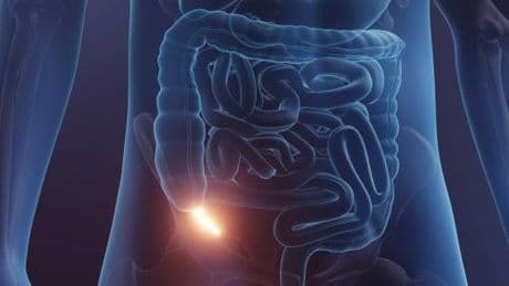 Cancro dell'appendice: cosa rivelano i nuovi studi