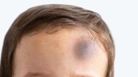 The Touch Test Every Parent Should Do After A Head Bump