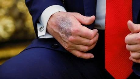 Donald Trump: Was kann hinter dem Bluterguss an der Hand stecken?