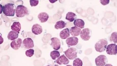 Scoperti due Rna circolari che predicono la leucemia più aggressiva