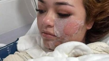 Young mum dies after passing out in hot tub and waking up to skin peeling off