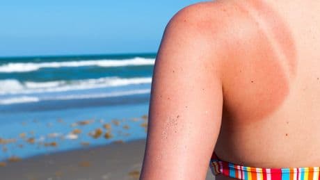 Skin cancer peaks in summer – so why is early detection still an afterthought?
