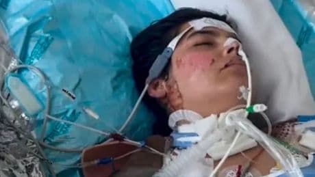 Dancer left with burns covering 90 per cent of body after fire dance goes wrong