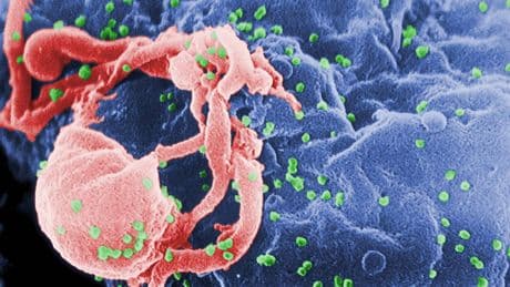 Türkiye’de yapılan çalışmada HIV ile yaşayan her 3 kişiden 1’inde frengi görüldü