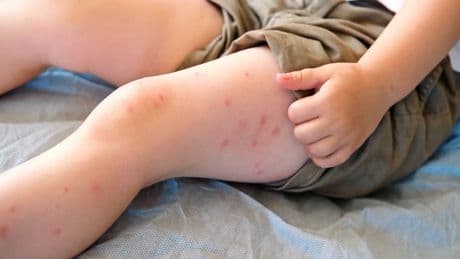 Soaring number of Alberta measles cases worries health officials in both Canada, U.S.