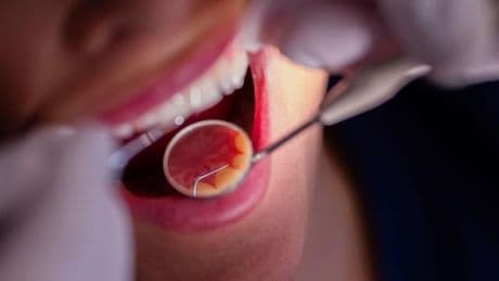 Vorsorge: Barmer: Zahngesundheit im Norden verbessert sich