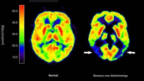 Schutz vor Demenz: Diese 14 Risikofaktoren sollten Sie ausschalten