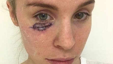‘A spot under my eye turned out to be skin cancer aged just 26’