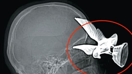 Man impales eagle statue into his eye socket & also narrowly misses his brain after falling on it in horror accident