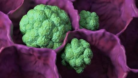 Cancer : ces cellules inflammatoires qui aggravent le pronostic des patients