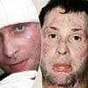 My schizophrenic uncle set me on fire leaving half my body covered in horrific burns - but this is how I look now thanks to a revolutionary new surgery