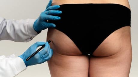 Brazilian butt crackdown begins in fight against cosmetic procedure ‘Wild West’