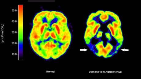 Alzheimer-Therapie: EU-Kommission lässt Wirkstoff Lecanemab gegen Alzheimer zu