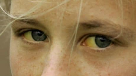 Científicos españoles ponen cara a la rara hepatitis que afecta a niños pequeños: no tiene que ver con los virus