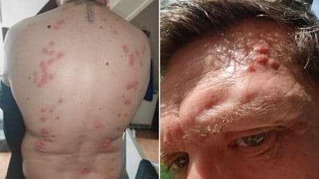 Man left covered in bed bug bites after hotel stay