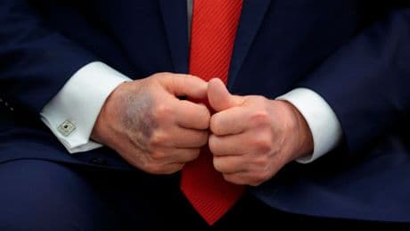 Trump Seen With Bruised Right Hand Again—Here’s Everything We Know About The Condition
