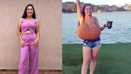 Sadece 300 kişide görülen hastalık: Göğüsleri aylar içinde 12 kiloya ulaştı