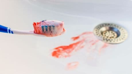 Häufig Zahnfleischbluten? Dieser Mangel könnte der Übeltäter sein