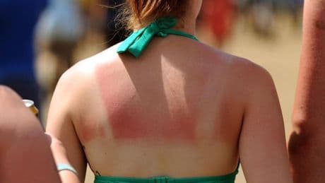 Doctor says there are six things you must do if you get sunburnt
