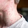 Health chiefs' urgent warning over record highs of deadly measles - are YOU in a hotspot?