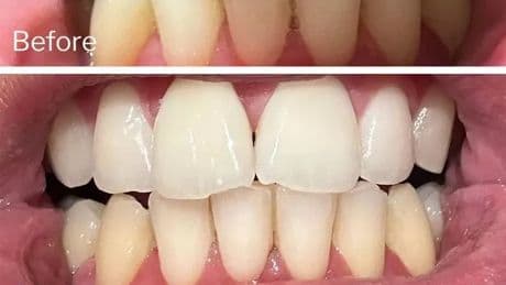 Dentist-backed 95p teeth whitening strips shoppers keep saying they'll 'buy again'