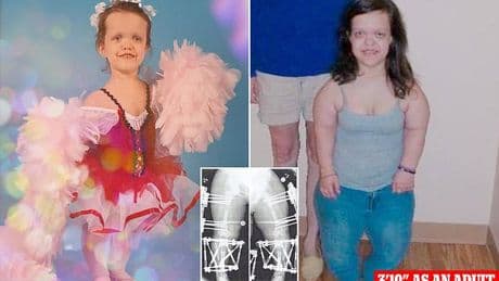 Teen who had controversial surgery to grow 13 inches reveals what she looks like now