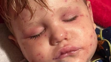 Boy, 2, fighting for his life after being stung by wasps 150 times while riding toy car
