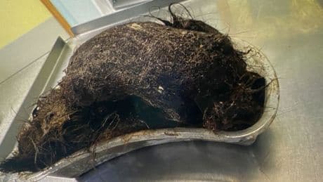 Groß wie eine Melone - Riesiger Haarballen aus Bauch von Mädchen entfernt