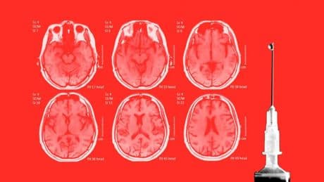 Así es el análisis de sangre que va a cambiar la forma de diagnosticar alzhéimer: "Se hará hasta en primaria"