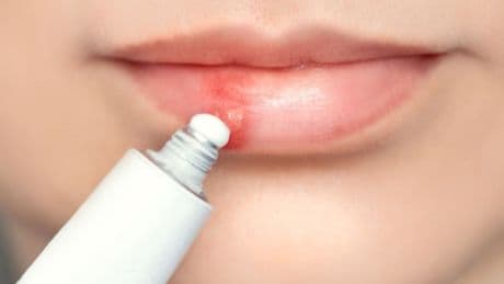 El herpes labial se asocia con mayor riesgo de Alzhéimer