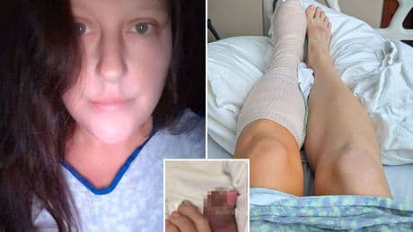 Mum, 42, left fighting for her life in septic shock and has foot amputated after spotting an ingrown nail
