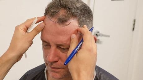 Wayne Bridge shows off impressive £7,000 hair transplant results after 'covering' his baldness