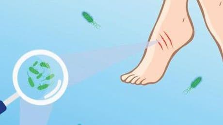 Plajlarda ‘Vibrio’ alarmı! Açık yarayla denize girmeyin