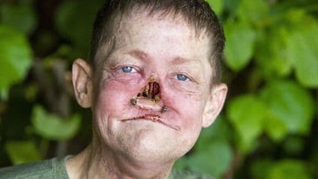 Man with "breathing pain" loses his nose after being diagnosed with cancer