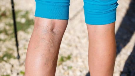 Krampfadern geplatzt: Varizenblutung – Was tun?