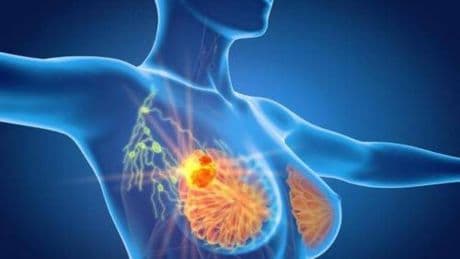 Tumore al seno triplo negativo, speranze da anticorpo farmaco-coniugato