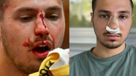 Brutalo-Foul in Österreich - Handball-Star mit Not-OP nach offenem Nasenbruch