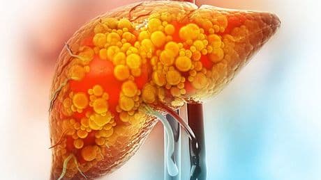 Scientists discover key cause of deadly liver disease - and new treatment could be on the horizon