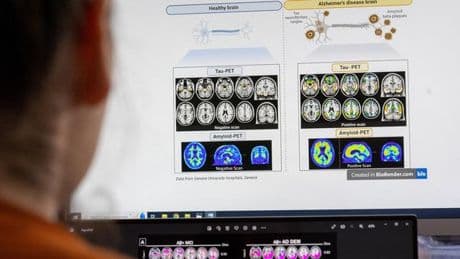 Leqembi: Was Sie zum neuen Alzheimer-Medikament wissen müssen